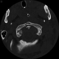 C1 Fracture