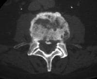 discitis on mri