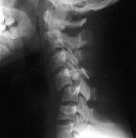 Cervical Spinal Stenosis: Patient History and Case