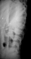 stable retrolisthesis stable retrolisthesis