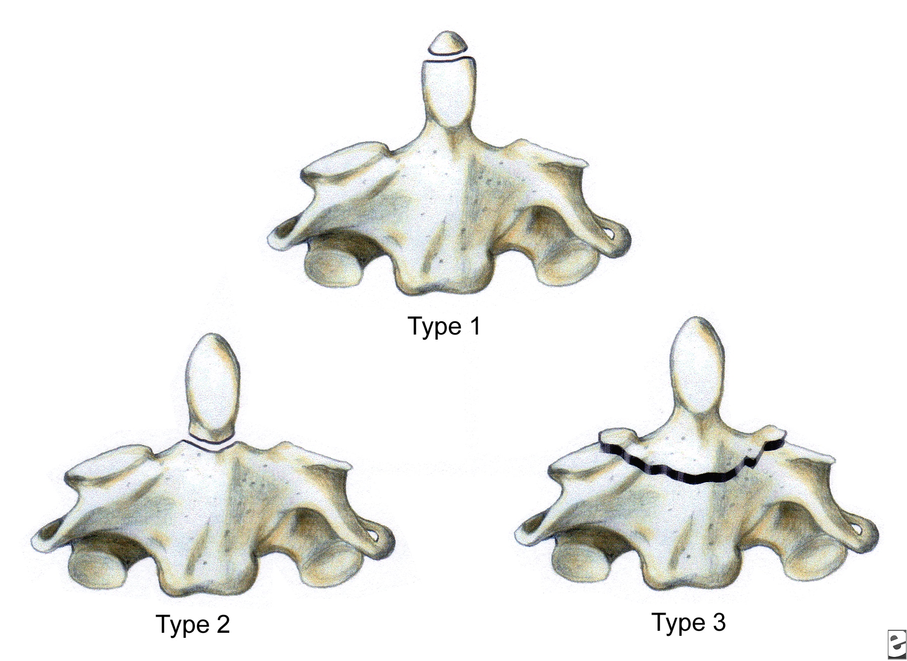 Three types of C2 odontoid fractures: type I is a...