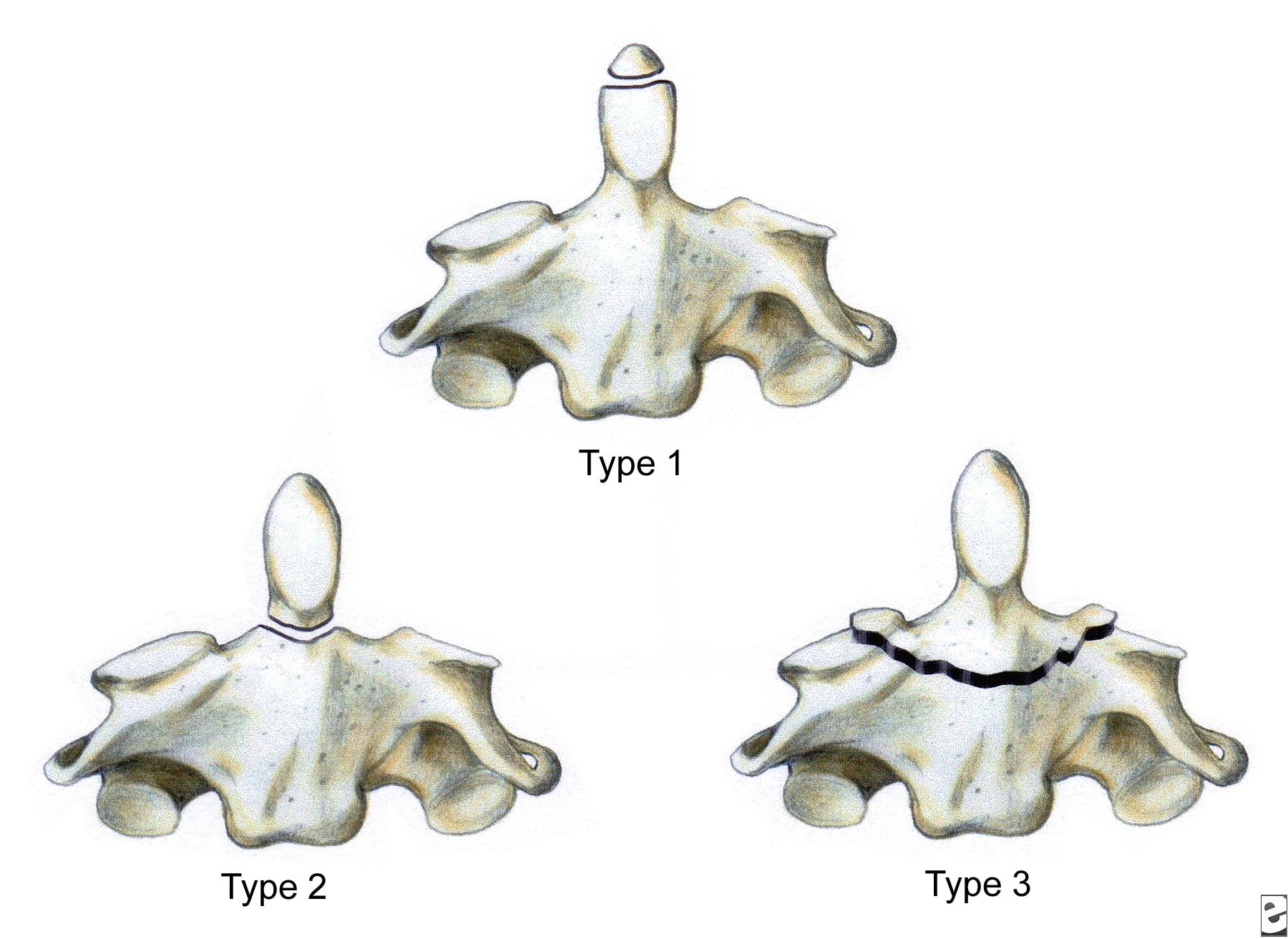 type 2 odontoid fracture x ray