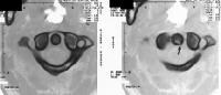 Odontoid type II fracture