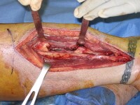 Dog Bite To Right Hand Icd Dog Bite To Right Hand Icd
