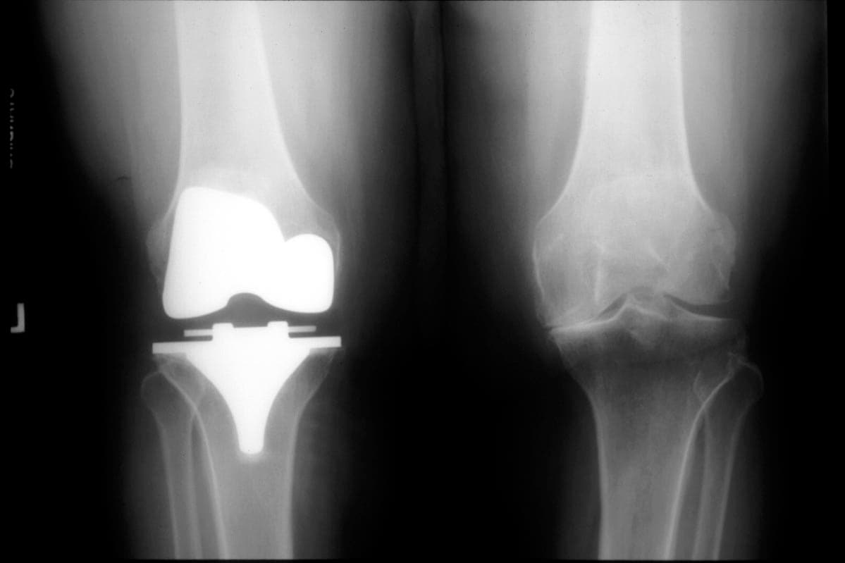 Knee Replacement Problems and Revision Surgery