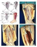 (Click Image to enlarge.) Single-incision fasciot...