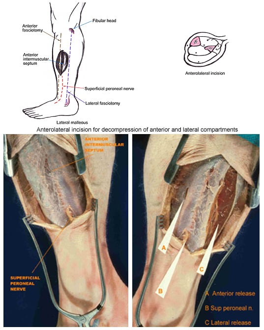 symptoms of compartment syndrome in lower leg