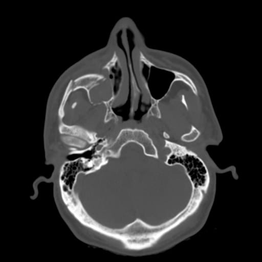 Axial CT scan demonstrating  zygomaticomaxillary c...
