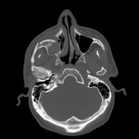 Axial CT scan demonstrating zygomaticomaxillary c...