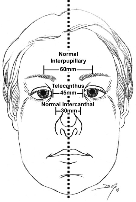 Midface dimensions are depicted.  A normal interca...