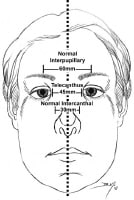 Midface dimensions are depicted. A normal interca...