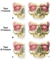 Nasoorbitoethmoid complex fractures are classifie...