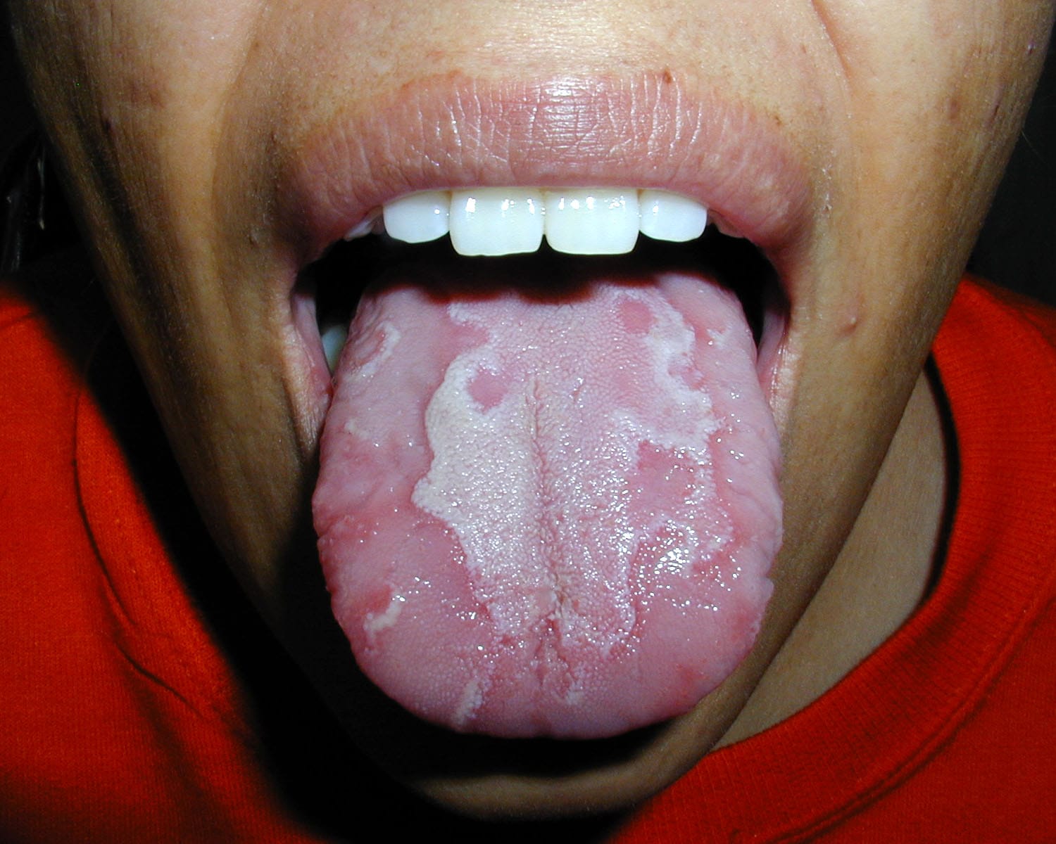 A 29-year-old female presents  with tongue irritat...