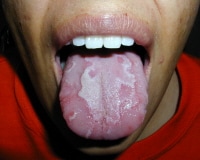 burning tongue syndrome