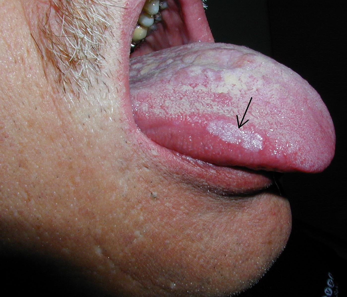 Oral Cancer Tongue