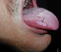 White Patch On Left Side Of Tongue