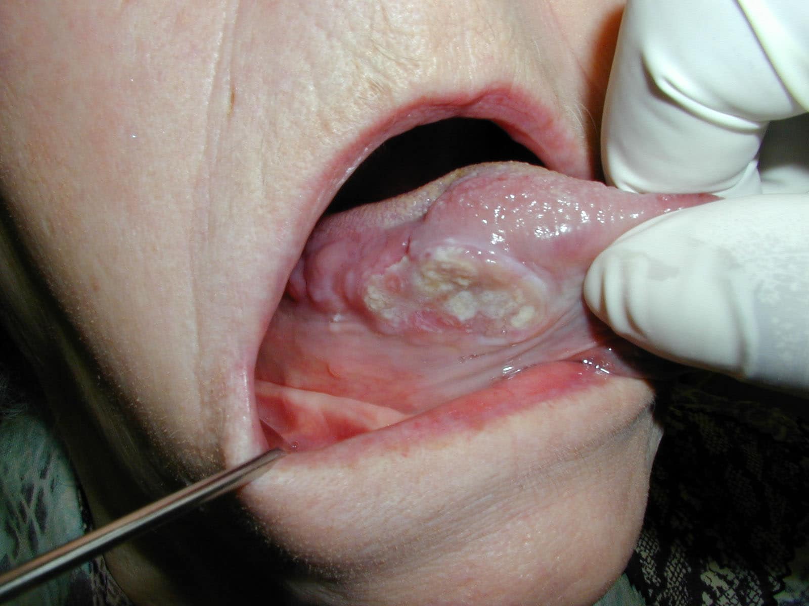 A 63-year-old female presents  with tongue discomf...