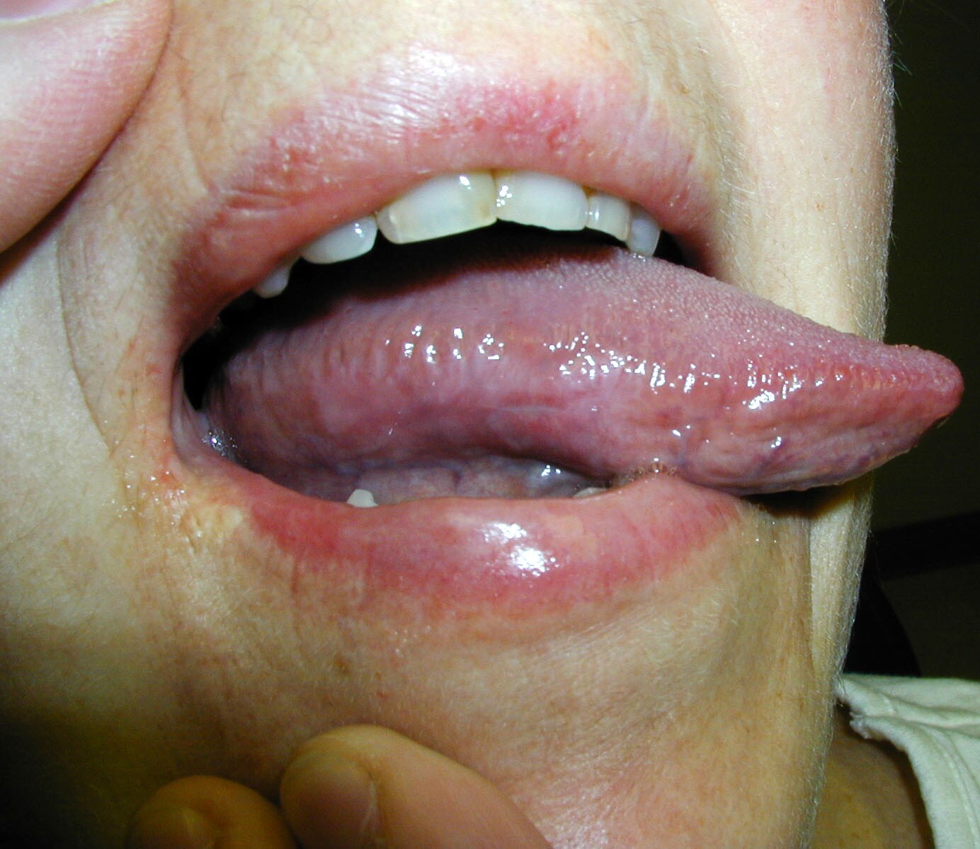 A 55-year-old female with tongue  burning for 15 m...