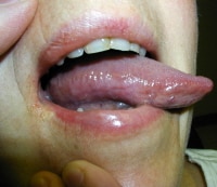 A 55-year-old female with tongue burning for 15 m...