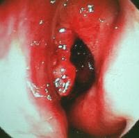 Typical view of a middle meatus in a patient with
