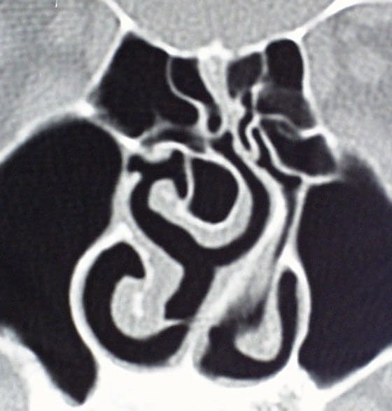 nasal septum tumor. Nasal Septum Tumor