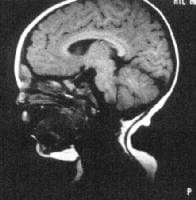 This MRI depicts a dermoid. The dermoid is intrac...