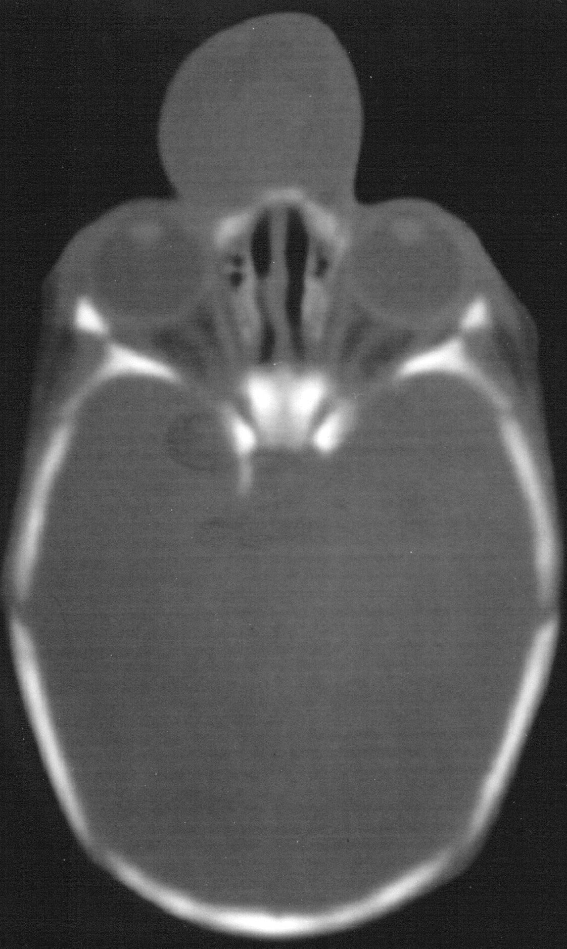 CT scan demonstrating  encephalocele.