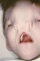 The photograph shows a child with median nasal cl...