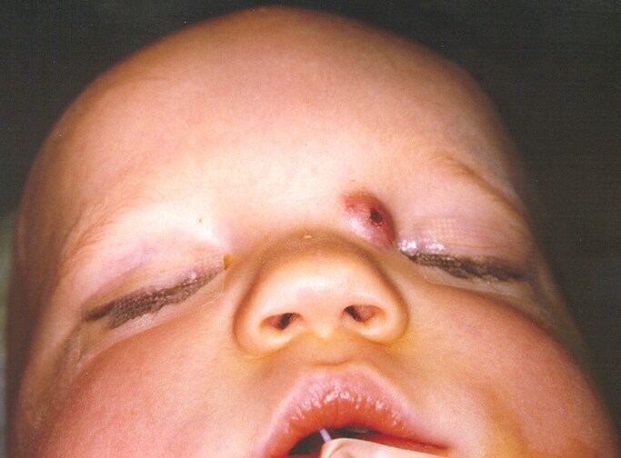 A patient with a congenital  nasal dermoid.