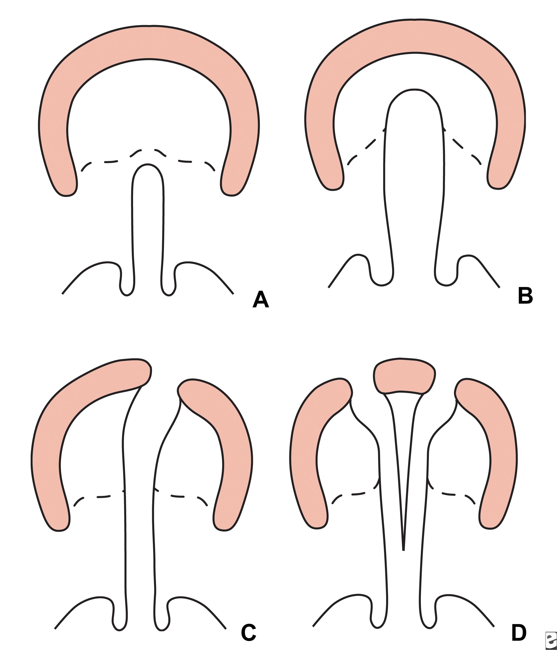 Veau classification of cleft lip  and palate.