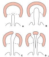 Veau classification of cleft lip and palate.