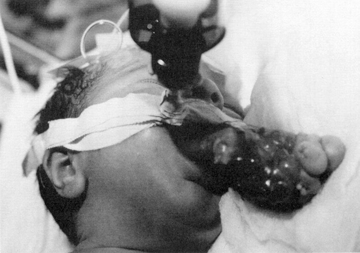 Newborn with epignathus. The  patient was intubate...