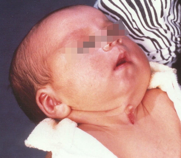 Three-week-old patient with  congenital midline ce...