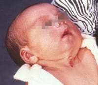 Three-week-old patient with congenital midline ce...