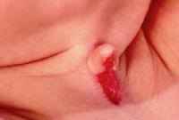 Close-up view of 3-week-old patient with congenit...