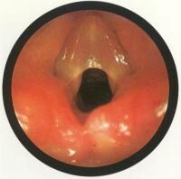 Congenital Laryngeal Web