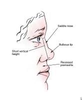 Saddle Nose Rhinoplasty