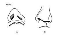 Nasal Dorsum Anatomy