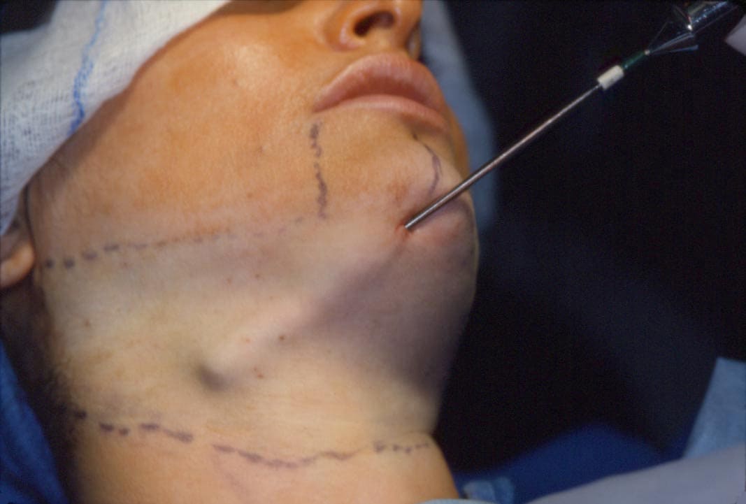 liposuction neck copy