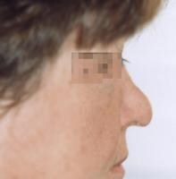 Nasal Scarring