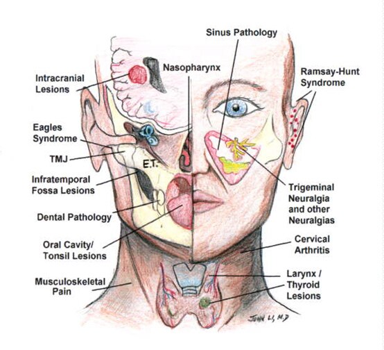 source of referred otalgia