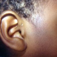 Swelling Below Ear