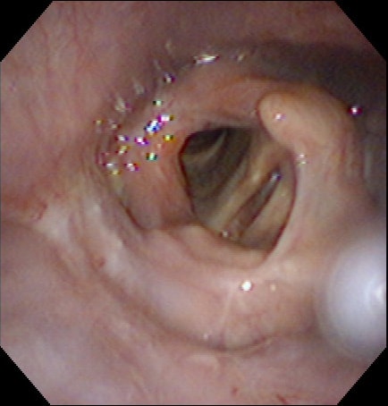 Right pyriform sinus cancer following laryngeal c.