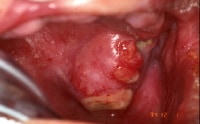 Oral Squamous Cell Carcinoma - Ear, Nose, and Throat ...