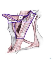 Selective neck dissection levels I-III. 