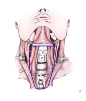 Selective neck dissection for thyroid cancer: sele