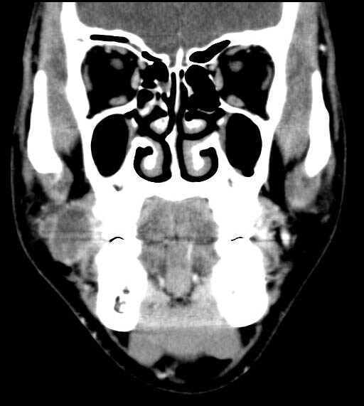 and the medial aspect of the right buccal fat pad. and the medial aspect of the right buccal fat pad.