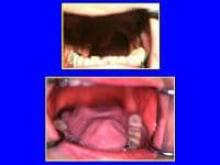 tongue glossectomy maxillofacial artificial total principles prosthetics general posterior elevations anterior speech shown note