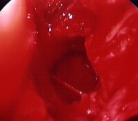 Anterior Epistaxis