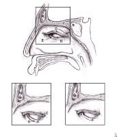 frontal recess